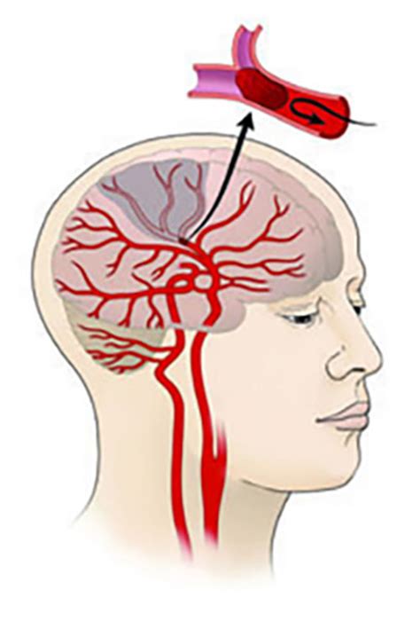 Trial Shows Importance Of Insulin Resistance In Stroke Brown University