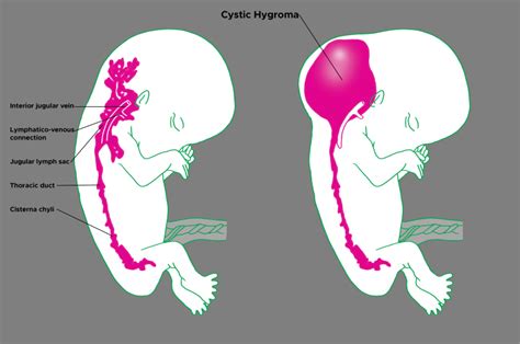 Figure Illustration Of Normal Fetus And Fetus With Cystic Hygroma