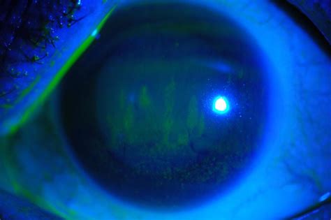 síndrome del ojo seco ¿qué es y cómo se produce miranza