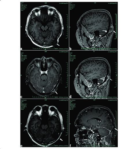 A B A Circular Abnormal Signal Is Seen On The Left Occipital Scalp