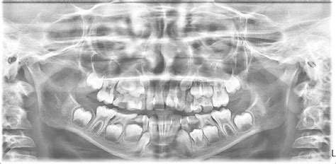 Non Syndromic Impacted Supernumerary Tooth A Case Report Dental