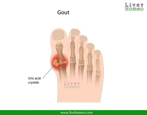 About 4 Stages Of Gout Arthritis Best Homeopathy Treatment For Gout