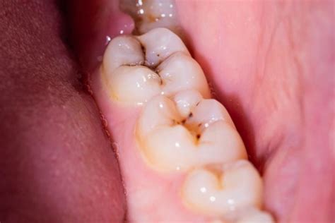 Dientes Picados Síntomas Y Tratamiento Sevilla Dental