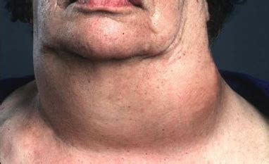 The lump may be limited to one of the two lobes of the thyroid gland and referred to as a nodule. Anaplastic thyroid cancer. Causes, symptoms, treatment ...