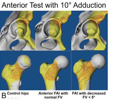 Posterior Hip Impingement