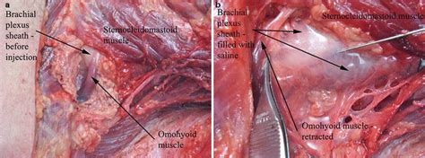 Brachial Plexus Block Radiology Key