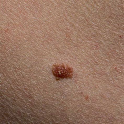 Skin Cancer Diagnosis Online Detection Of Skin Cancer