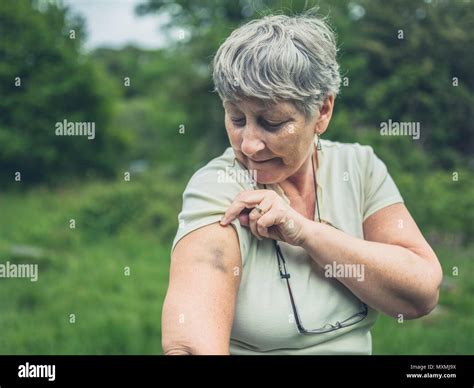 Bruise Arm Hi Res Stock Photography And Images Alamy