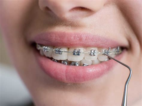 Orthodontics Fixed Braces Ceramic Metal Fast Braces