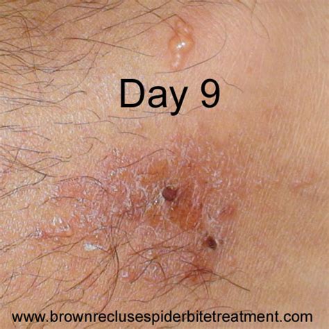 Brown Recluse Spider Bite Treatment