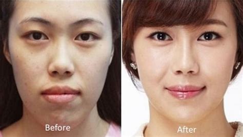 81 Photos Of Plastic Surgery In Korea That Will Make Your