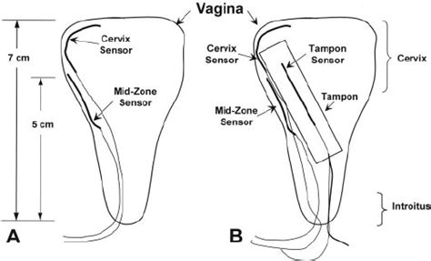 We did not find results for: Placement of vaginal sensors in vaginal canal pre ( A )- and post ( B... | Download Scientific ...