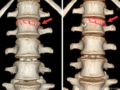 L2 Vertebral Body Compression Fracture And Surgical Repair