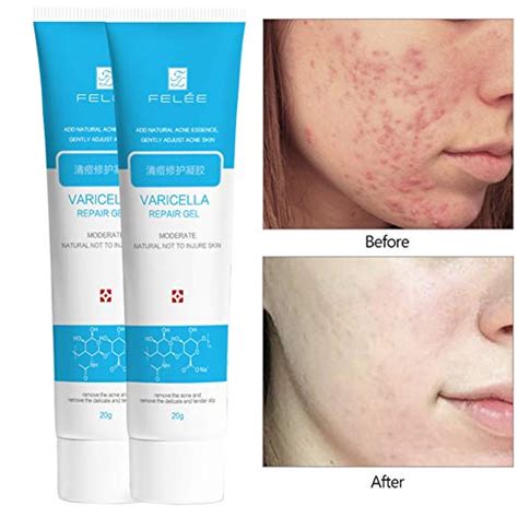 How can i get rid of cut marks on my face? The Best Cream is Used to Remove Pimples (With images ...