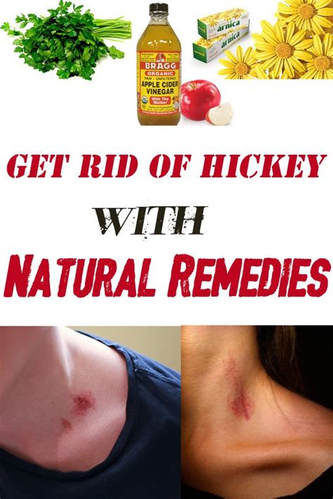 Get Rid Of Hickey With Natural Remedies Everything In One Place