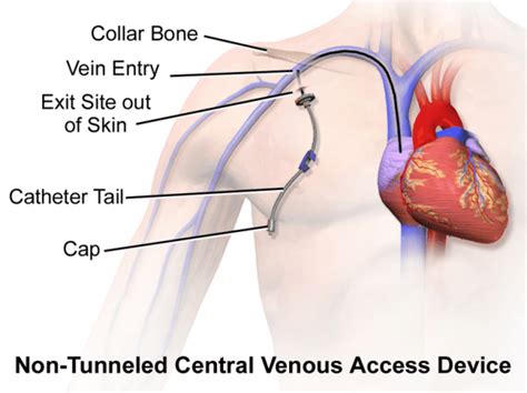Central Venous Catheter Cvc And Its Placement