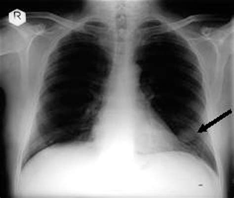 Chest Radiograph Showing A Coin Shaped Lesion In The Lower Lobe Of