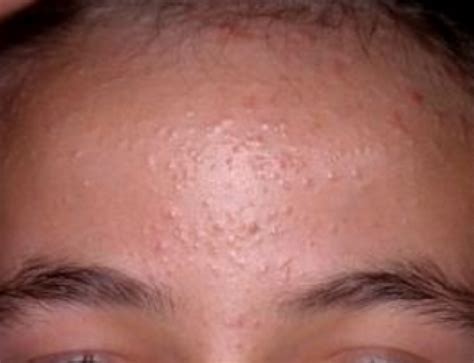 Skin Rash Small Bumps On Face