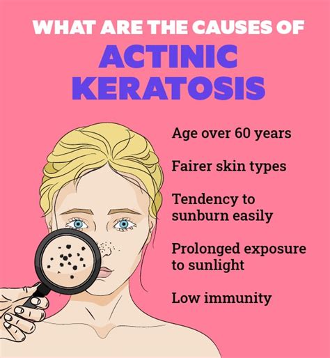 Actinic Keratosis Causes Symptoms Treatment And Prevention Portal