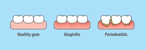 Six Signs Of Unhealthy Gum My Dentist Burbank