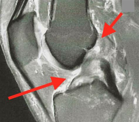 Diagnostic De La Rupture Du Ligament Crois Ant Rieur