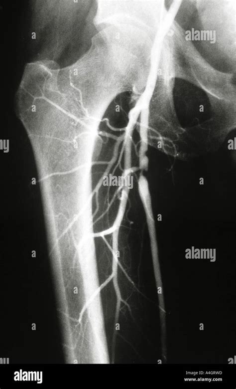 An Angiogram Also Called An Arteriogram Of The Leg Showing