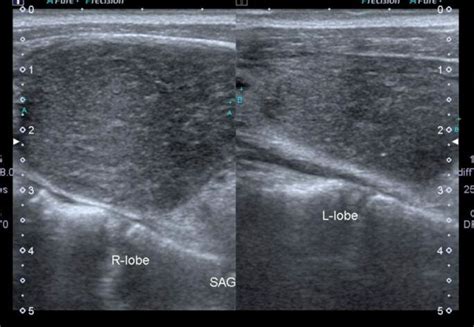 Ultrasound Of The Thyroid Gland Showing An Enlarged Right Lobe Of