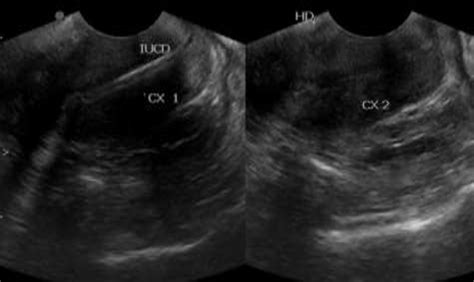 Transvaginal Ultrasound Sagittal Images Showing Two Cervical Cavities