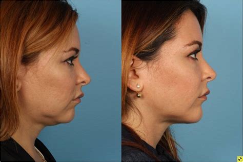 Before After Pictures Chin Submental Liposuction Chicago Ildr Sidle