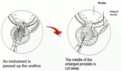 Transurethral Resection Of The Prostate