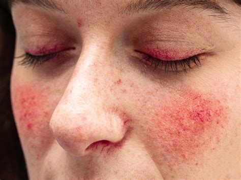 Rosacea Symptoms Causes And Treatments Guides