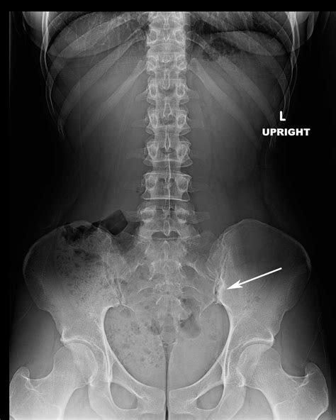 Normal Sacroiliac Joint X Ray