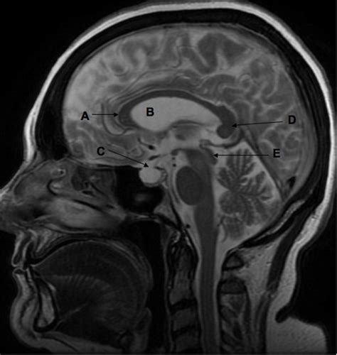 Sagittal View Of Brain Mri