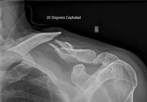 Clavicle Fractures Dr David Duckworth