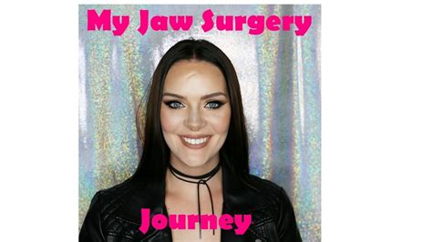 My Double Jaw Surgery Journey Gummy Smile And Overbite Before And
