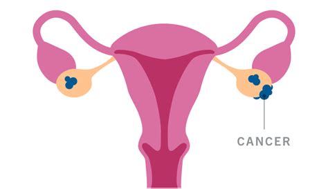 Genentech Understanding Ovarian Cancer