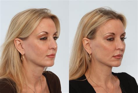 Neck Lift Procedure Everything You Need To Know About Bombay Cosmetic Clinic