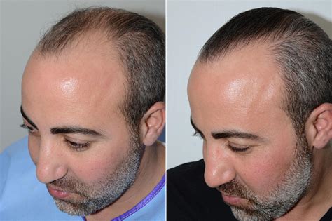 Hair Transplants For Men Photos Miami Fl Patient59522