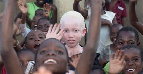 Media Briefing High Level Meeting On Persons With Albinism In Africa