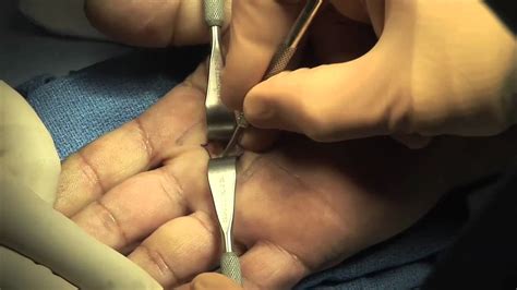 Trigger Release Hand Surgery Performed By Dr Hildreth In Houston