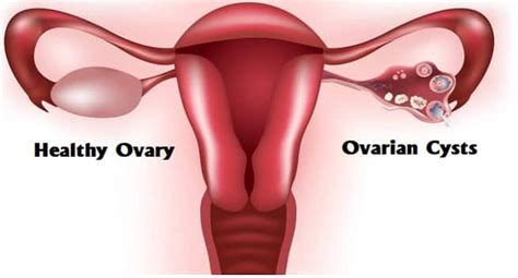 Know The Difference Between Ovarian Cysts And PCOS TheHealthSite Com