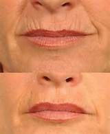 Lip Wrinkles Home Remedies Pictures