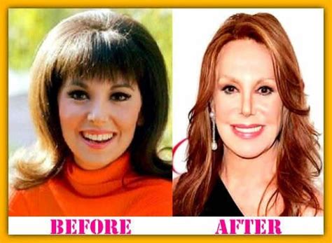 Marlo Thomas Plastic Surgery Celebrity Plastic Surgery Marlo Thomas