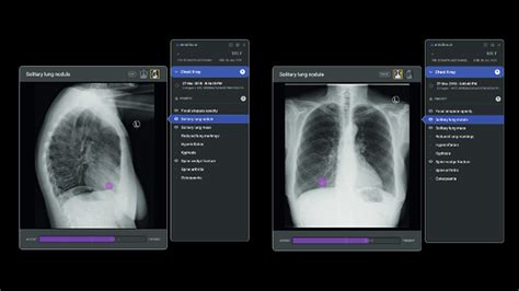 Chest X Ray Interpretation Better With Ai Healthcare Radius