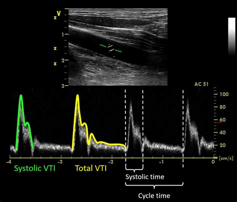 Doppler Ultrasonography Of The Left Common Carotid Artery Red Line
