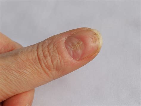 Bruzdy na paznokciach poznaj najczęstsze przyczyny ich powstawania