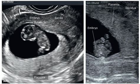 Placenta And Umbilical Cord Radiology Key