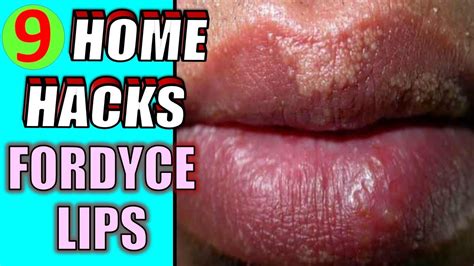 How To Get Rid Of Fordyce Spots At Home Quickly 9 Home Remedies For Fordyce Spots On Lips