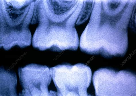 X Ray Of A Childs Healthy Molar Teeth Stock Image M7800217