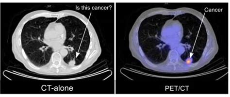 What Does A Ct Scan Of Lung Cancer Look Like Ct Scan Machine Images